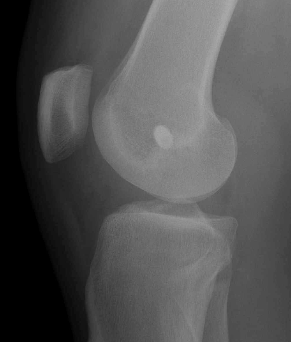 LCL Reconstruction Lateral